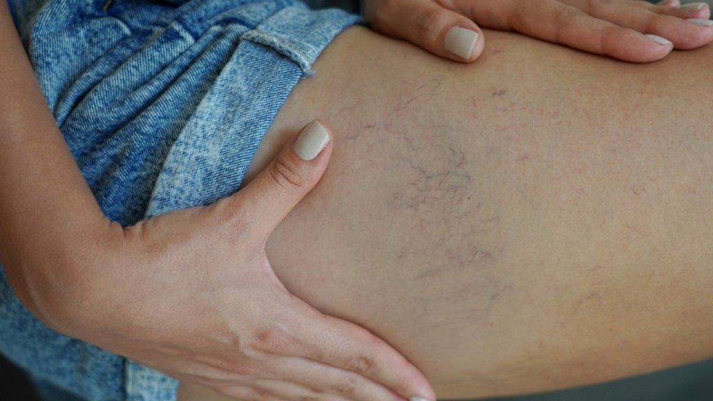 Besenreiser: unschön, aber meist ungefährlich