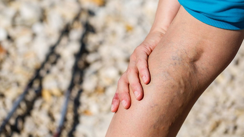 Krampfadern ambulant operieren