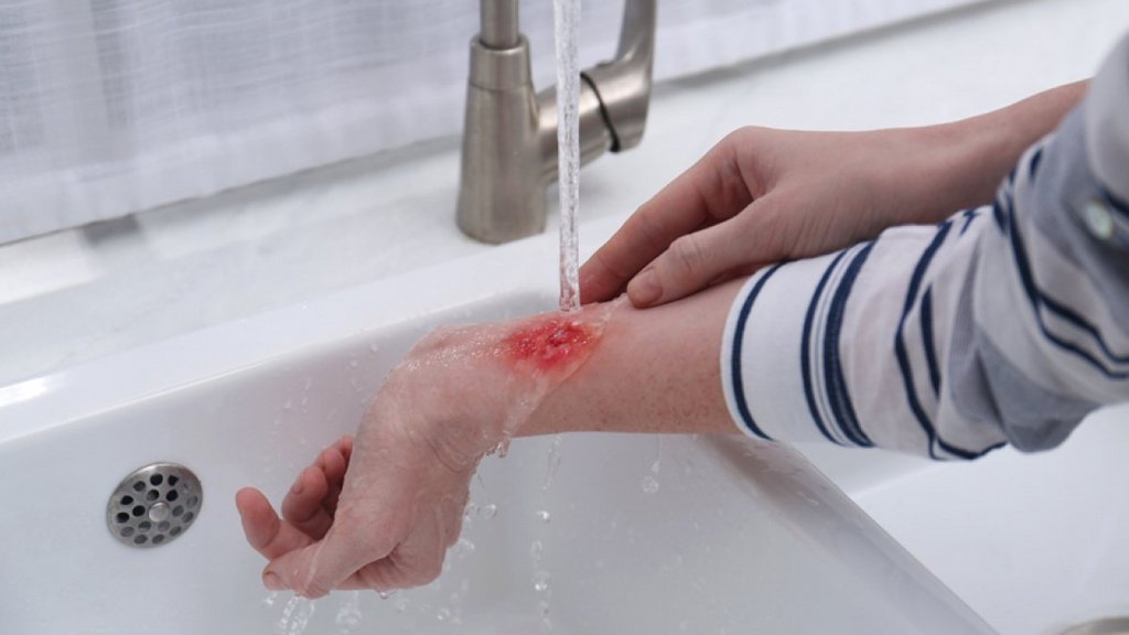 Spiel mit dem (Grill-)Feuer: Brandwunden richtig behandeln